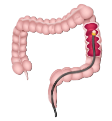 colonoscopy_